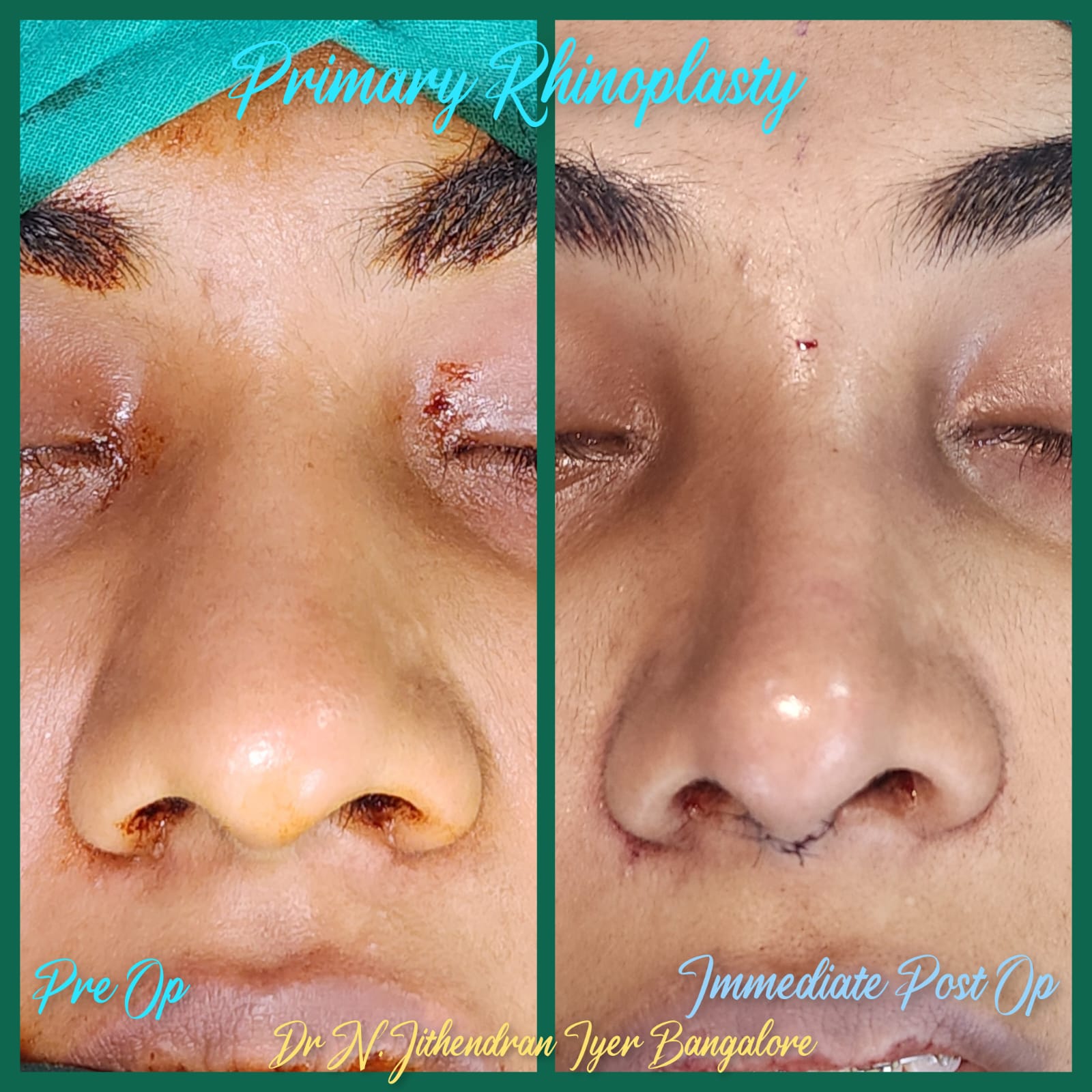 Septo Rhinoplasty