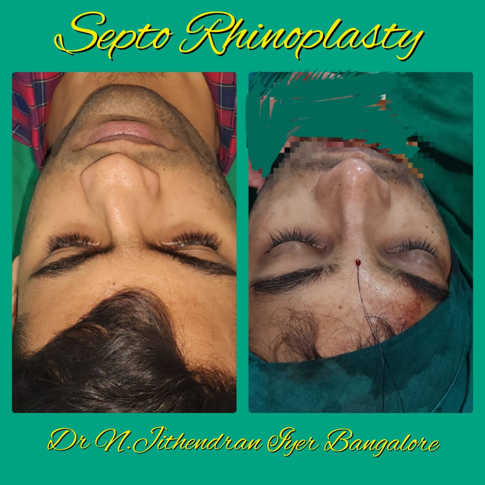 Septo Rhinoplasty