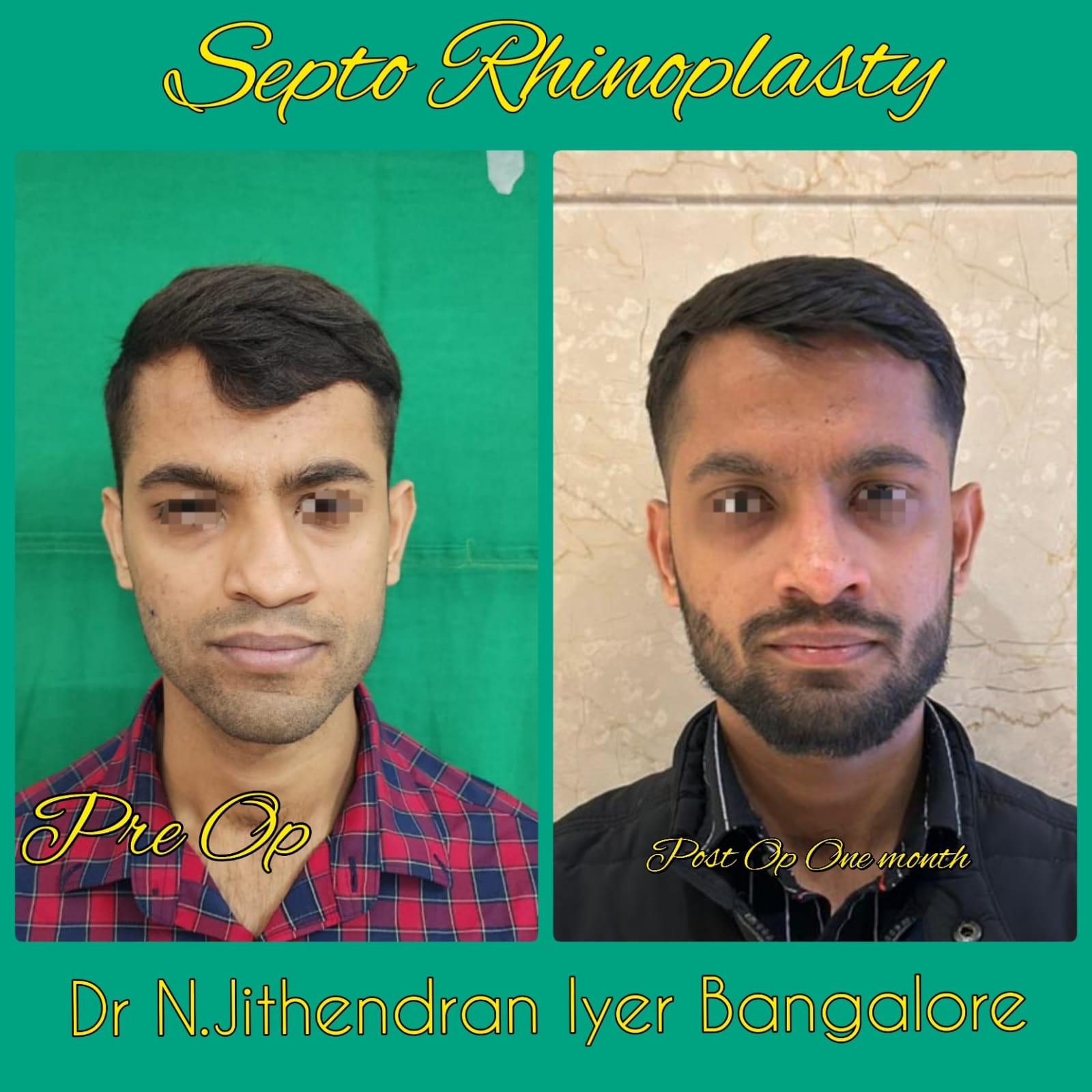 Septo Rhinoplasty