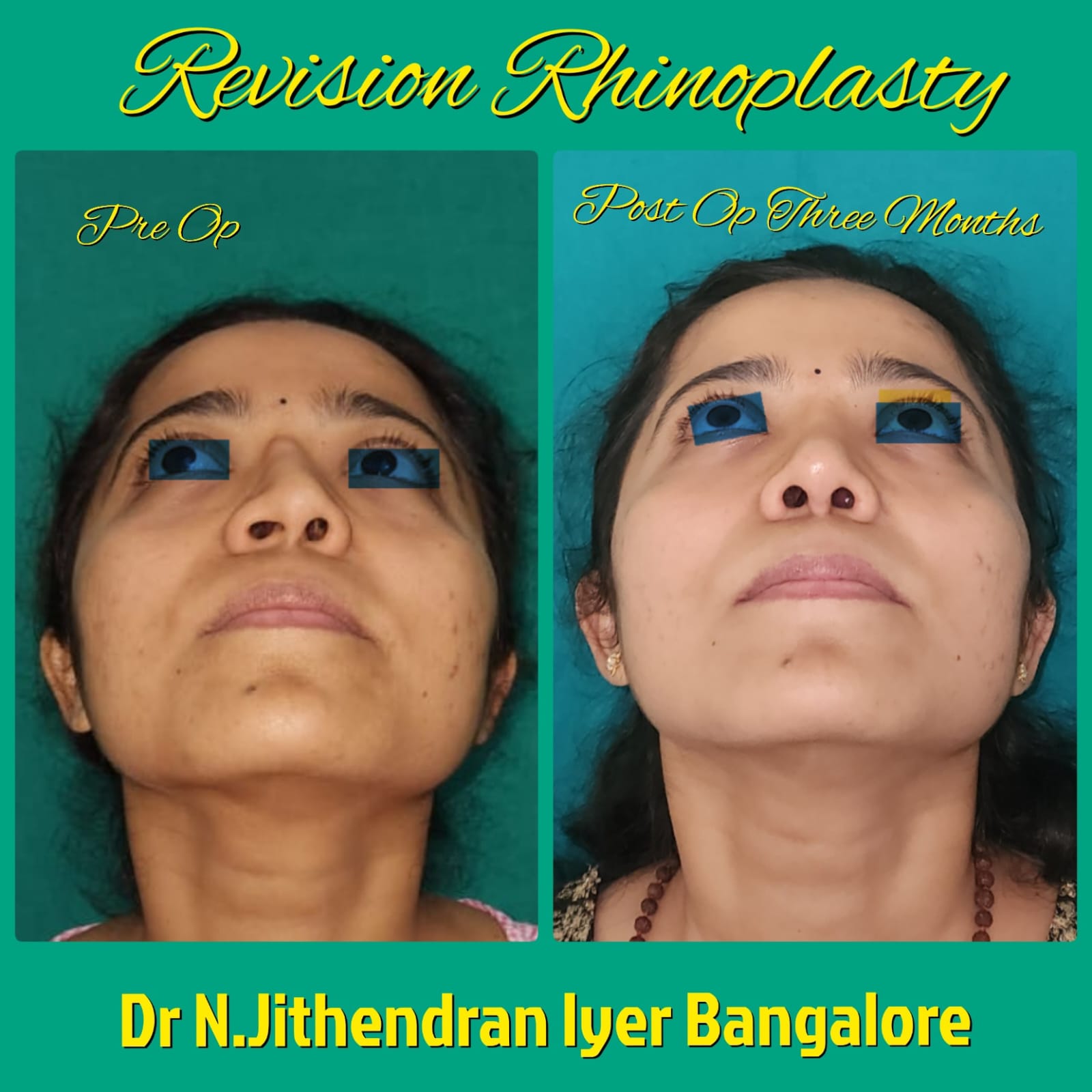 Septo Rhinoplasty