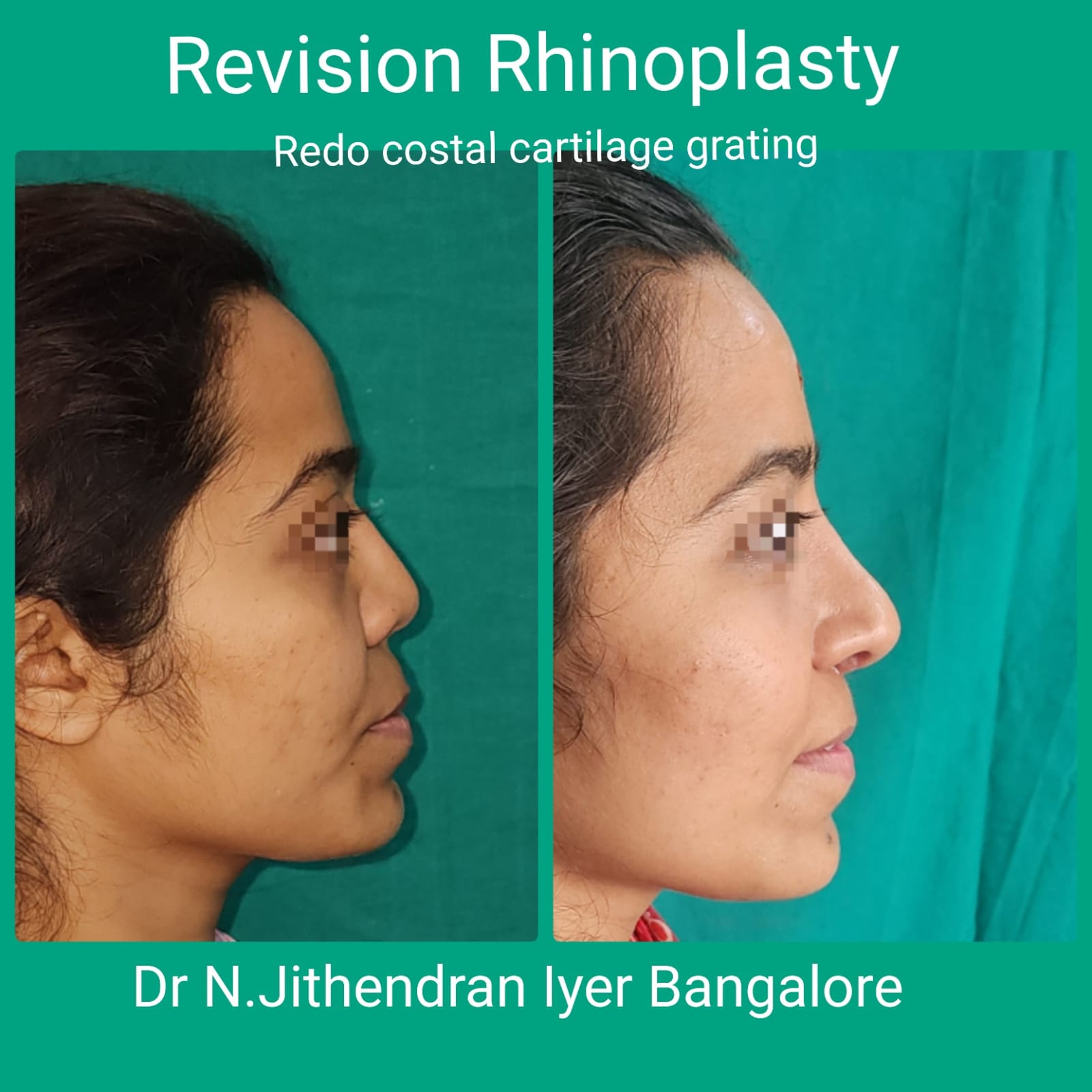Septo Rhinoplasty