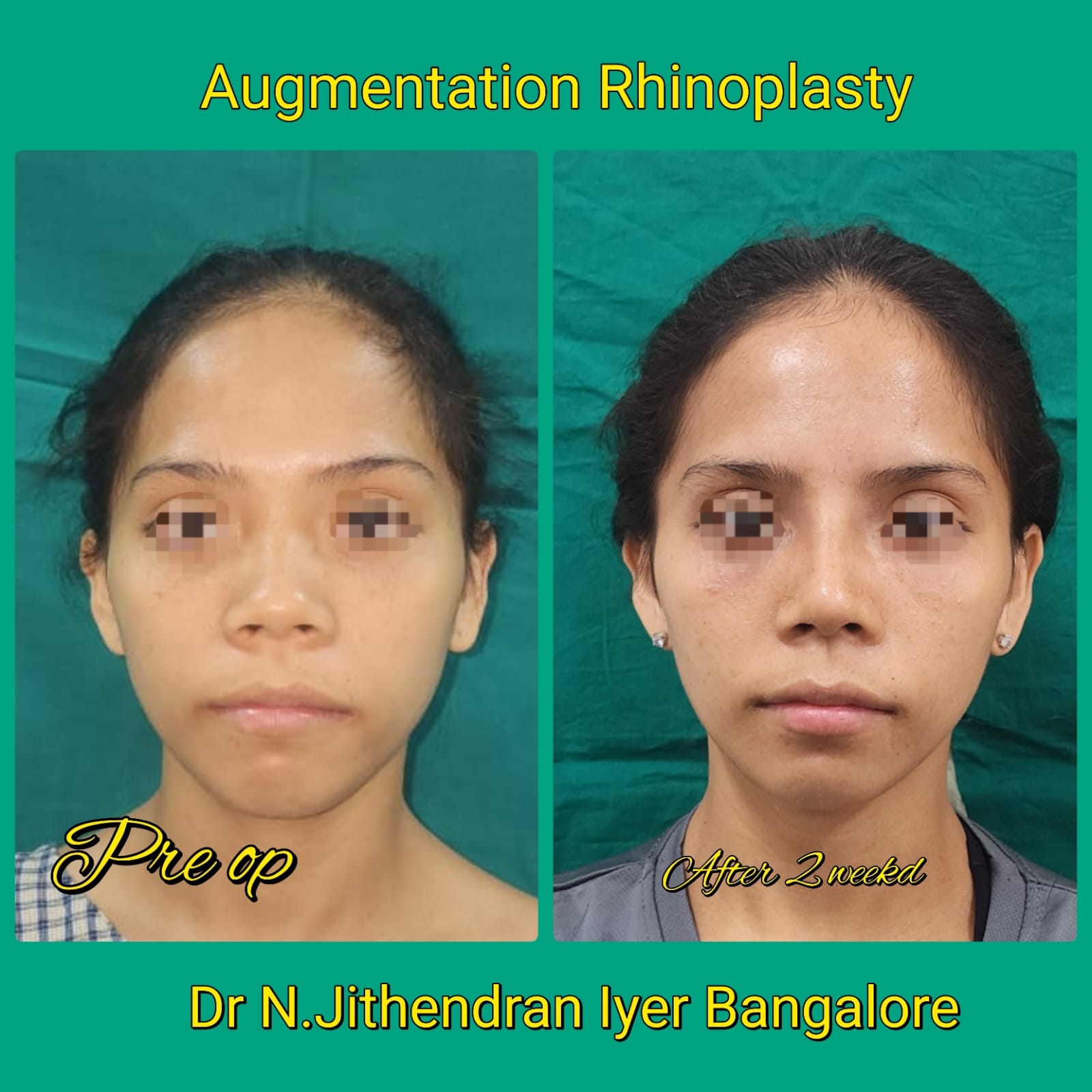 Septo Rhinoplasty