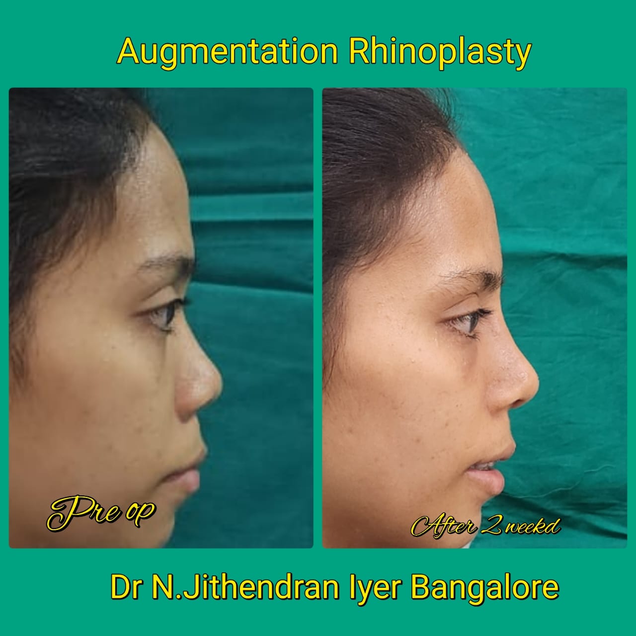 Septo Rhinoplasty