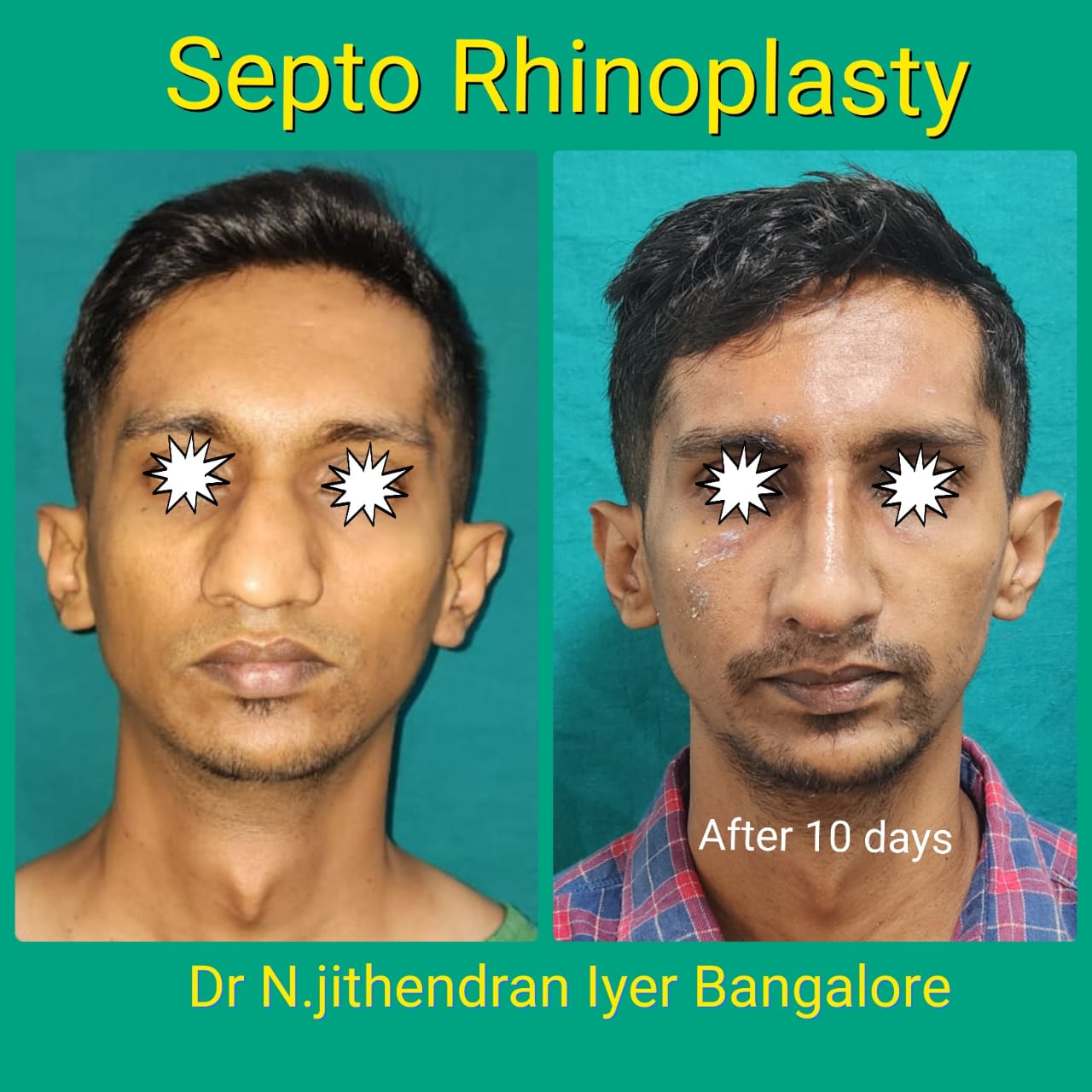 Septo Rhinoplasty