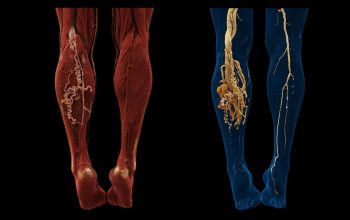 cVRT-images-show-posterior-view-of-AVM-in-detail_1800000006606421